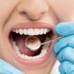 Dente cariato: le cause, prevenzione e cura
