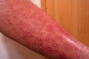 Dermatite atopica: cause, sintomi e cura nei bambini